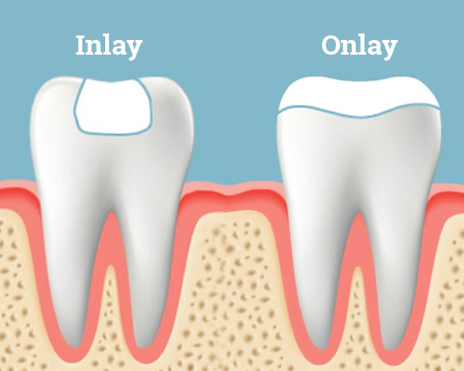 inlays & onlays - Cascade Dental Care