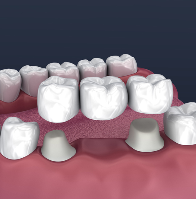 Dental Bridges - cascade dental care