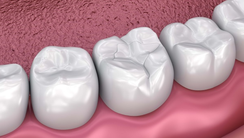 Dental Sealants - Cascade Dental Care