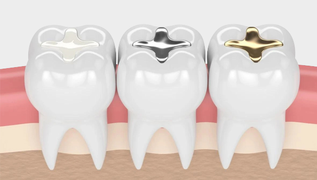 Tooth Colored Filings For kids
