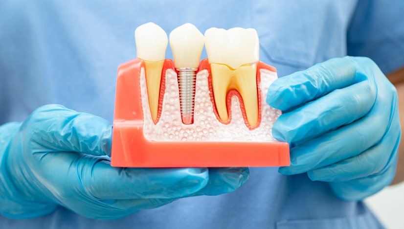 Dental Implants Treatment
