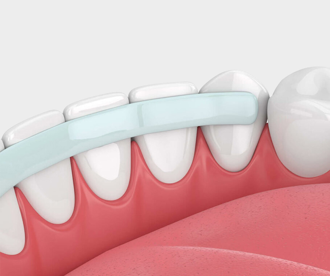 Dental Bonding - Cascade dental Care