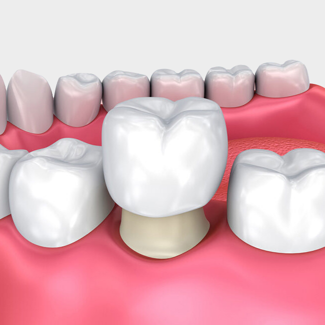 dental crowns - cascade dental care