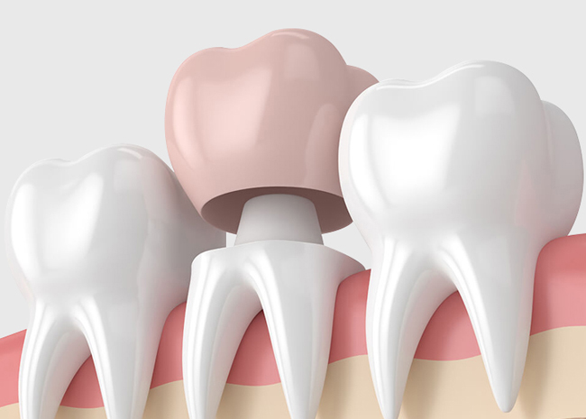 Dental crowns for children - cascade dental care