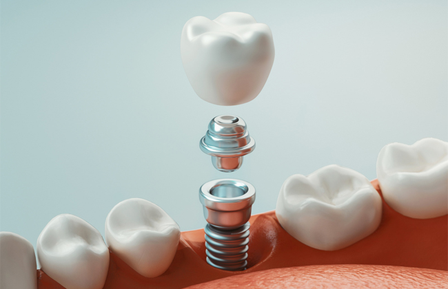 Dental implants -cascade dental care