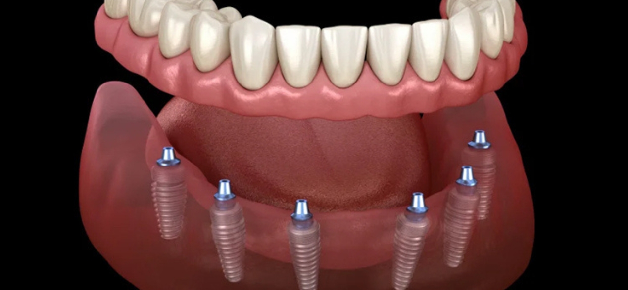 Mini Dental Implants A Game-Changer for Patients with Severe Bone Loss